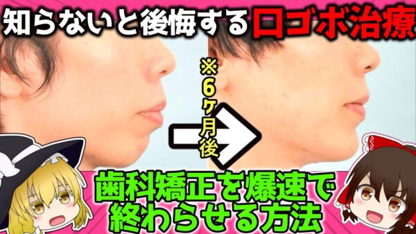 【歯列矯正】これをやったら矯正が1年で終わるらしい【横顔美人】