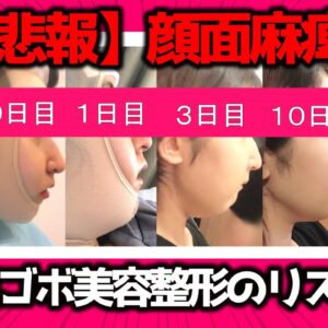 【病院公開/後遺症】セットバック手術の疑問すべて答える【口ゴボ】