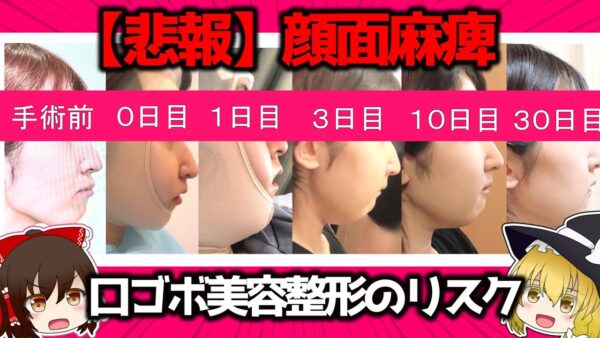 【病院公開/後遺症】セットバック手術の疑問すべて答える【口ゴボ】