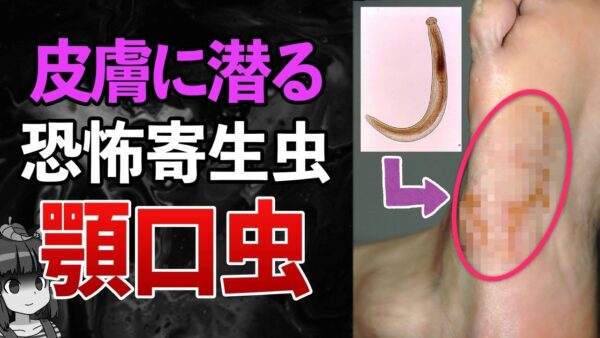 【顎口虫】腸を食い破り皮膚の下へ…青森で初確認された奇妙な寄生虫