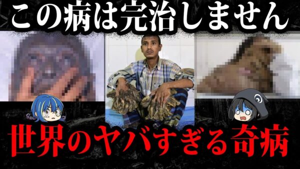 日本人も発症します。実在する怖すぎる奇病７選-2【ゆっくり解説】