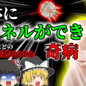 【2004年】皮膚にトンネルができる奇病？我慢できない