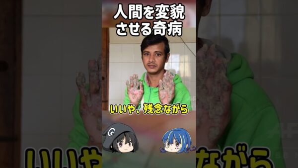 【１分解説】人を変貌させるツリーマン症候群とは？【ゆっくり解説】#shorts