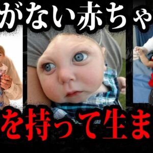 生まれながらに難病…とんでもない姿で生まれた子供たち５選【ゆっくり解説】