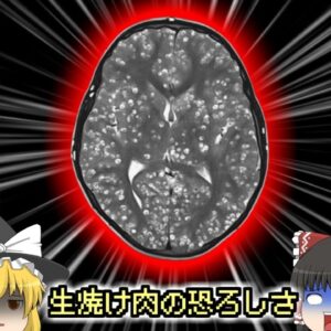 【2019年】謎の頭痛精神錯乱…恐ろしい症状で病院に運ばれた少年 脳が寄生虫だらけになり4亡 原因は生焼けの豚？『インド嚢虫症4亡事故』【ゆっくり解説】