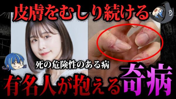 【ゆっくり解説】命に関わる病…有名人が抱える奇病５選