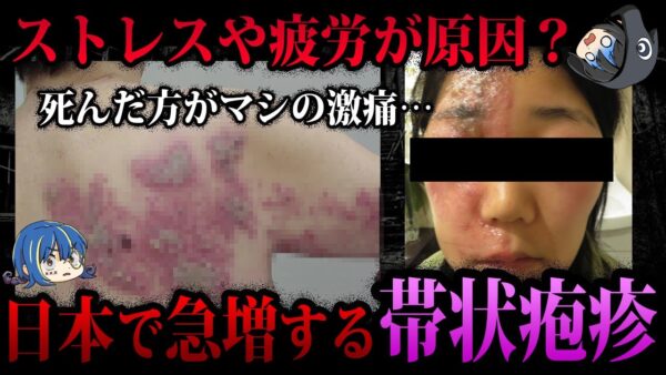 【ゆっくり解説】ストレスで発症率急増中！？日本で増加する帯状疱疹