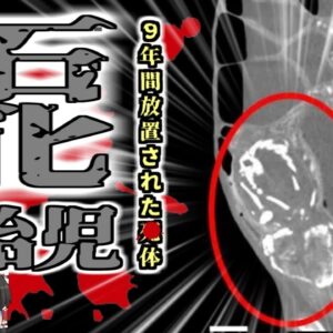 【2023年】『リソペディオン』　｜女性「お腹から変な音がする…」→腹部に石灰化した胎児が埋まっていた女性 ｜医者への不信から10年病院にかからず栄養失調で〇亡【ゆっくり解説】