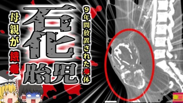 【2023年】『リソペディオン』　｜女性「お腹から変な音がする…」→腹部に石灰化した胎児が埋まっていた女性 ｜医者への不信から10年病院にかからず栄養失調で〇亡【ゆっくり解説】