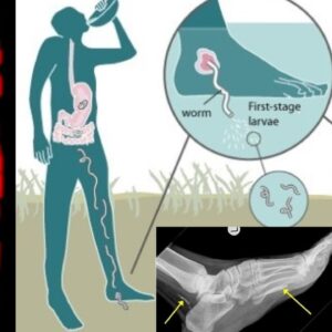 【2014年】「なんか足が痛いな…」→寄生虫が成長し体を喰い続けていた|最終的に足を目指し体を喰い進む不思議な寄生虫『ギニアワーム症』 【ゆっくり解説】