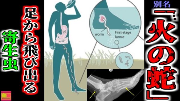 【2014年】「なんか足が痛いな…」→寄生虫が成長し体を喰い続けていた|最終的に足を目指し体を喰い進む不思議な寄生虫『ギニアワーム症』 【ゆっくり解説】