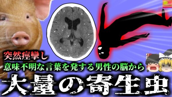 【2021年】意味不明な言葉を発し痙攣した男性 脳を調べるとそこには大量の白い影…『マサチューセッツ 有鈎の嚢虫感染症』【ゆっくり解説】