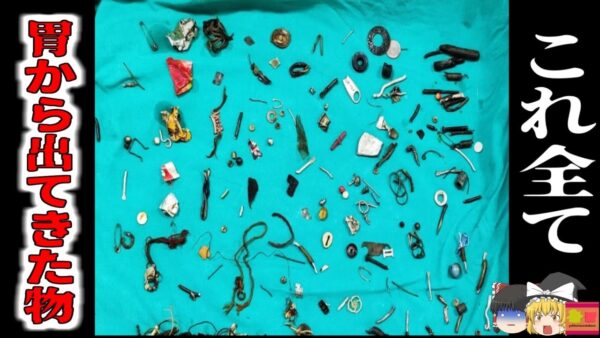 【2023年】腹痛を訴える男性 体内から150個以上の大量の鋭利な金属やアクセサリを摘出 彼はコッソリと何を食べていた？ 【ゆっくり解説】
