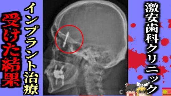 【2024年】激安歯科クリニックでインプラント手術を受けた男性 土台のスクリューが顎を貫通して脳まで達する 『インプラント医療事故』【ゆっくり解説】