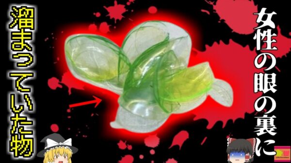 【2022年】「あれ…?コンタクト外したっけ？…まぁいっか」忘れて着けるの繰り返しで目の裏側に大量のコンタクト 両目の裏からソフトコンタクトが24枚も摘出された女性【ゆっくり解説】