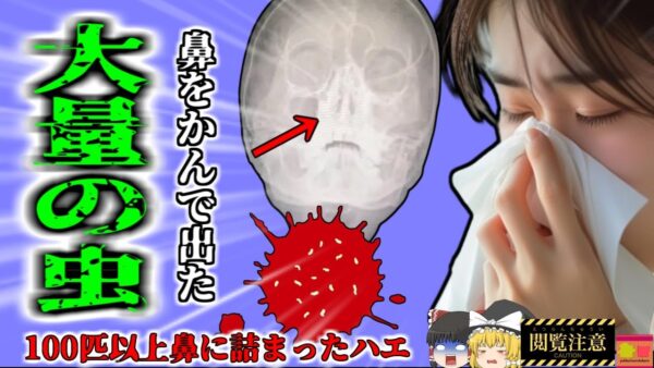 【2024年】「なんか鼻の調子が悪いわね…」→鼻をかんだら大量のウジムシが血液と共に噴出 鼻腔から数百匹のウジを摘出した女性『ハエウジ感染症』【ゆっくり解説】