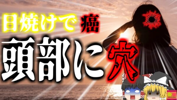 【2018年】「最初は小さなホクロだった」 長時間の日焼け用ベッド使用で頭部にガン 治療で頭に穴が開いてしまった女性　日焼け止めを塗らなかった部位に恐ろしい症状【ゆっくり解説】