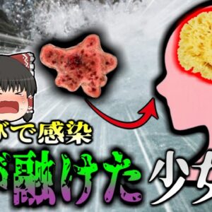 【2016年】夏に川遊びをしていた女子高生 帰宅後風邪のような症状が現れ昏睡 緊急搬送されるも〇亡 脳を調べてみると組織が…温かい自然の水に潜む『人喰い細菌』【ゆっくり解説】