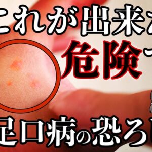 【注意】大人も感染する「手足口病」とはなんなのか？知っておくべき症状と対策