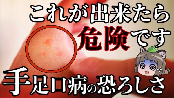【注意】大人も感染する「手足口病」とはなんなのか？知っておくべき症状と対策