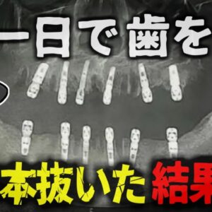 <span class="title">【2024年】『一日に23本歯を抜いた』一度に大量抜歯し、12本のインプラント埋入手術を受けた男性が死亡 (中国)【ゆっくり解説】</span>