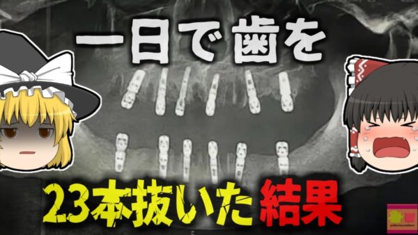 【2024年】『一日に23本歯を抜いた』一度に大量抜歯し、12本のインプラント埋入手術を受けた男性が死亡 (中国)【ゆっくり解説】