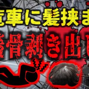 <span class="title">【2024年】『頭皮が全て剥がれた』お祭り中、観覧車に長い髪の毛を巻き込まれた少女 頭皮が丸ごと剥がれる重傷を負い危篤状態に…【ゆっくり解説】</span>