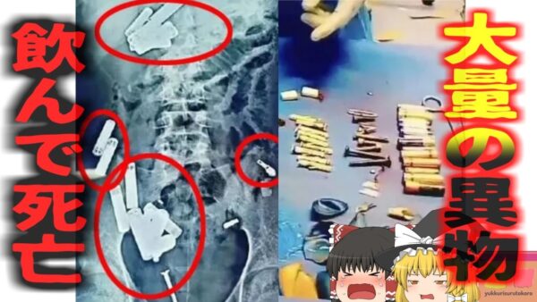 【2024年】『腸からカミソリや電池が出てきた』体調不良を訴えた子供 検査を受けた結果体内に56個大量の異物 摘出されるも翌日にこの世を去る【ゆっくり解説】