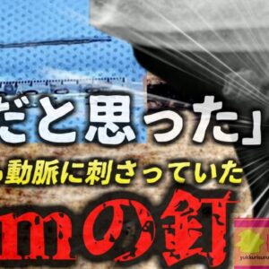 【2024年】『魚の骨だと思った』肉料理を食べ喉に違和感を覚えた女性 検査した結果喉に刺さっていたのは骨ではなく『5cmの釘』その状態で一カ月も過ごしており…【ゆっくり解説】