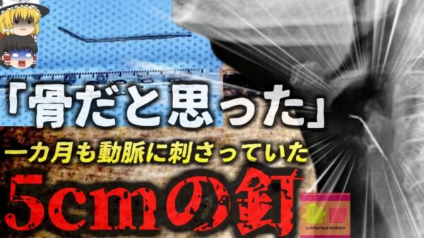 【2024年】『魚の骨だと思った』肉料理を食べ喉に違和感を覚えた女性 検査した結果喉に刺さっていたのは骨ではなく『5cmの釘』その状態で一カ月も過ごしており…【ゆっくり解説】