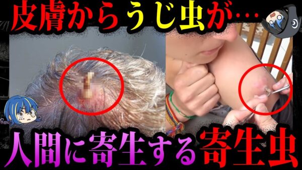 【ゆっくり解説】グロすぎて閲覧注意。人間に寄生する寄生虫５選