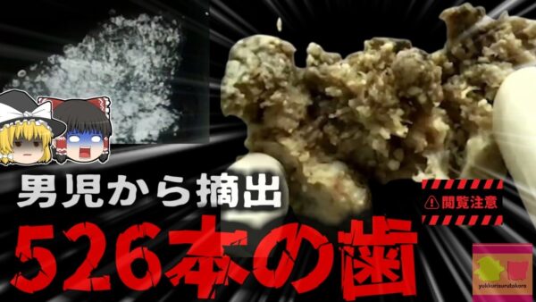 【2019年】『7歳の子から526本の歯』顎の痛みを訴える子供のレントゲン撮影をしたところ、顎に大量の歯が詰まった袋を発見 全身麻酔で摘出される【ゆっくり解説】