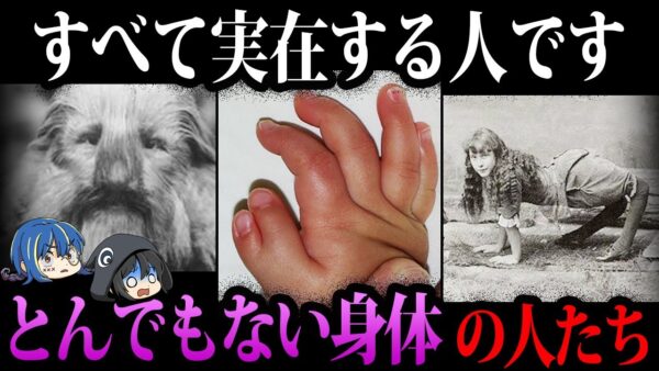【ゆっくり解説】衝撃的すぎる…とんでもない身体で生まれてきた人５選