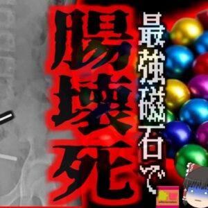 『超強力磁石で緊急手術』中学生がネットで『ネオジム磁石』を購入　約200個飲み込んだ結果、腸壁が挟まれ壊死…緊急開腹手術へ【ゆっくり解説】