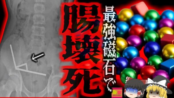 『超強力磁石で緊急手術』中学生がネットで『ネオジム磁石』を購入　約200個飲み込んだ結果、腸壁が挟まれ壊死…緊急開腹手術へ【ゆっくり解説】