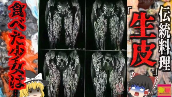 『伝統料理で全身に寄生虫』農村部の女性が全身症状で検査を受けると恐ろしいCT写真が…10歳から『豚の刺身』を食べていた結果…『雨崩村有鉤条虫感染症』【ゆっくり解説】