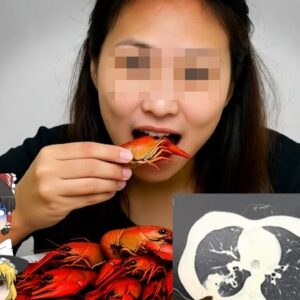 『ザリガニで肺が穴だらけに』大量のザリガニを食べた女性　発熱や吐血、呼吸困難などを発症し検査を受けると…『長沙市肺吸虫感染』【ゆっくり解説】